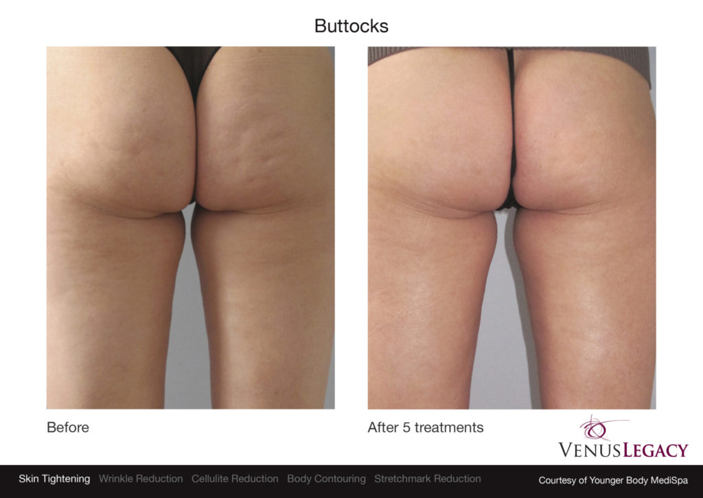 Cellulite Reduction Skin Tightening - Apex Center For Regenerative